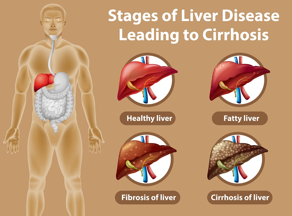 Liver Cirrhosis
